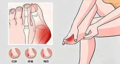 你的脚正常吗？五种常见的足部变形